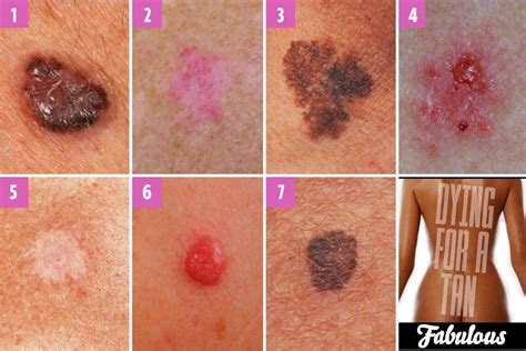 Breast cancer symptoms: What chest freckles can mean